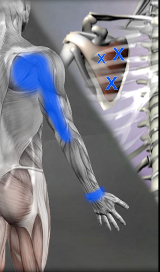 Subscapularis TP