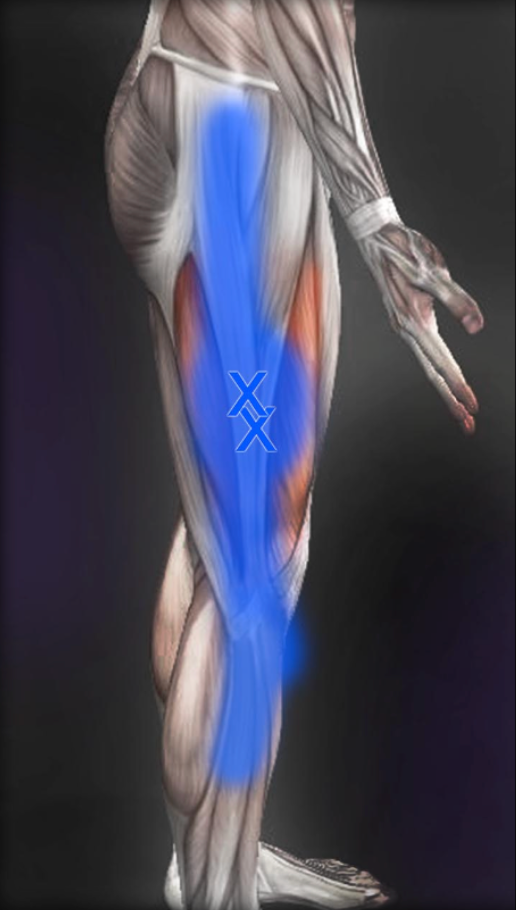 Vastus Lateralis TP